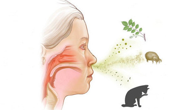 Eficacia de la acupuntura en el tratamiento de la rinitis alérgica
