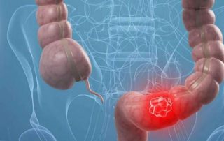 Eficacia de la acupuntura para el tratamiento del síndrome de colon irritable