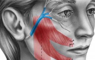 Eficacia de la acupuntura para el tratamiento de la parálisis facial