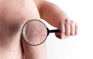 Efecto de la combinación de Medicina Tradicional China y fototerapia uvb de banda estrecha en el tratamiento de la psoriasis de severa a moderada