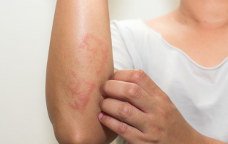 Efectividad de la acupuntura en el tratamiento de la dermatitis atópica leve y moderada