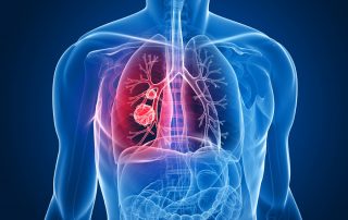 Acupuntura en el tratamiento de la enfermedad pulmonar obstructiva crónica: ensayo multicéntrico, aleatorizado y controlado