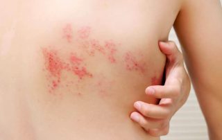 Eficacia de la acupuntura en el tratamiento del herpes zóster: revisión sistemática y metaanálisis