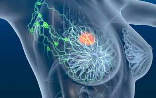Acupuntura y moxibustión en el tratamiento del linfedema asociado a cáncer de mama: revisión sistemática y metanálisis