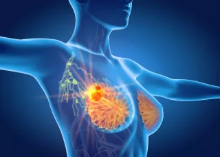 Acupuntura y moxibustión en el tratamiento del edema linfático asociado a cáncer de mama: revisión sistemática y metaanálisis