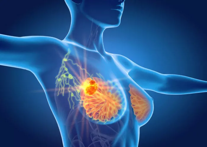 Acupuntura y moxibustión en el tratamiento del edema linfático asociado a cáncer de mama: revisión sistemática y metaanálisis