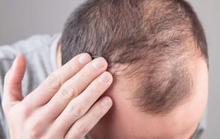 Eficacia de la Medicina Tradicional China en el tratamiento de la alopecia androgénica refractaria: revisión sistemática y metaanálisis