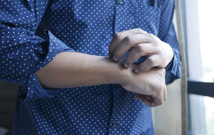 Acupuntura para la urticaria crónica: revisión sistemática y metaanálisis con análisis secuencial de ensayos
